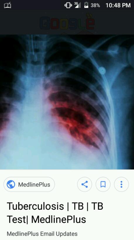 Little bit about Tuberculosis ( TB) 