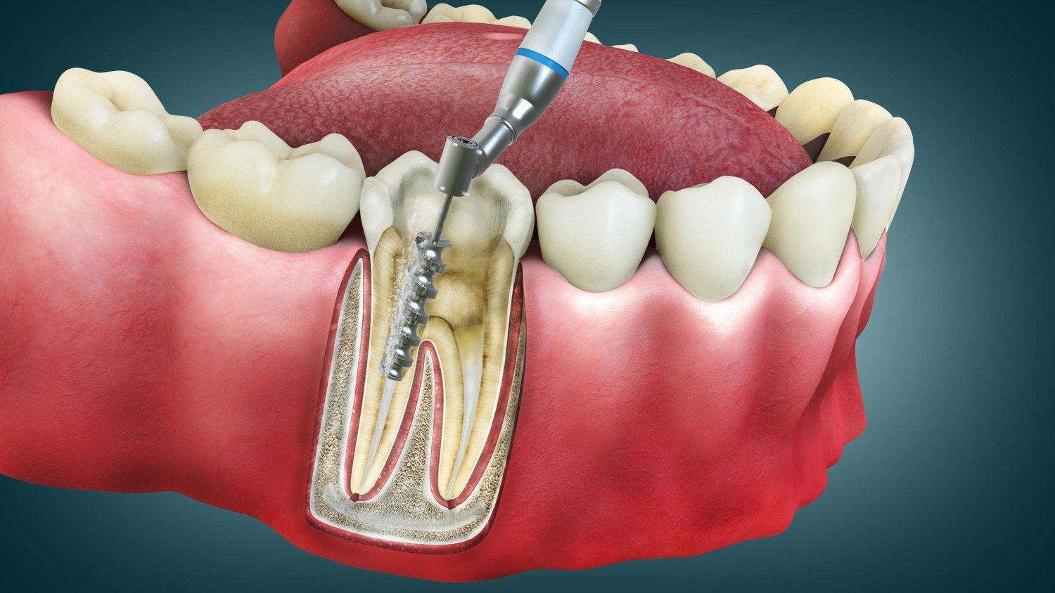 How to Prepare for a Root Canal: Tips to Ease Anxiety
