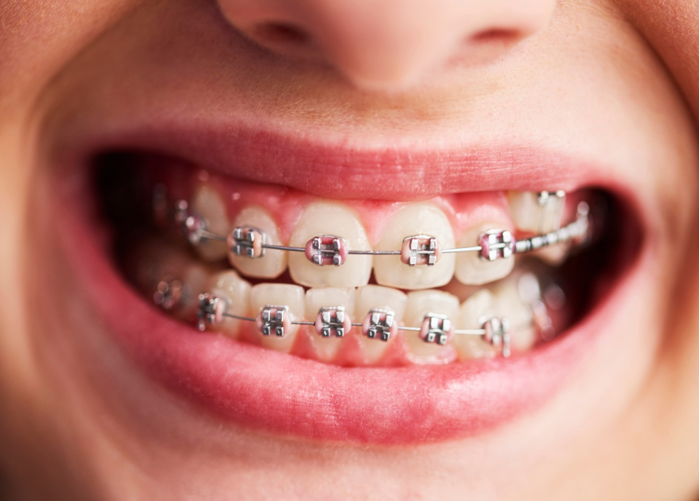 Braces for Kids in Kolkata: Cost, Process, and Best Age to Start