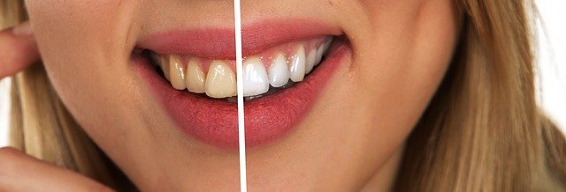 Should you take a whitening process or product to whiten your teeth?